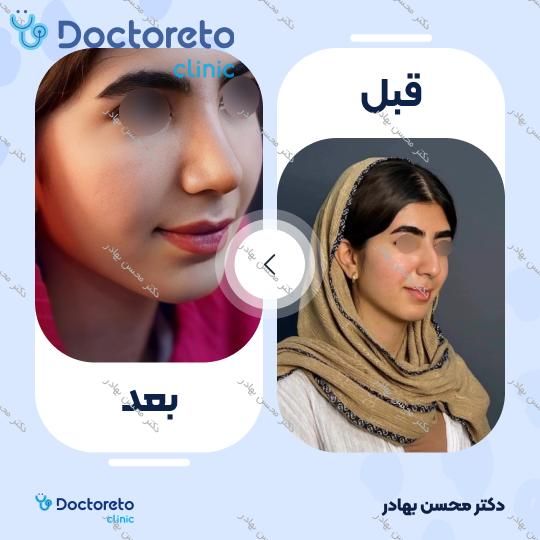 جراحی انحراف بینی (سپتوپلاستی) دکتر محسن بهادر در مرودشت 2