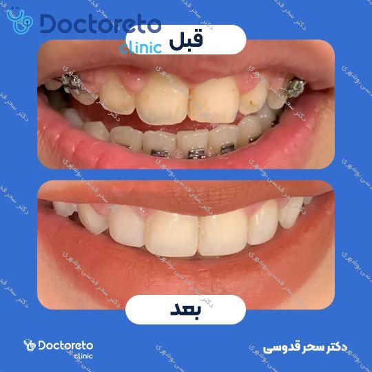 ونیر کامپوزیت توکویاما ژاپنی (هر واحد)