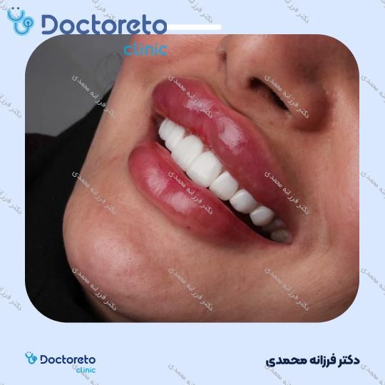 ونیر کامپوزیت توکویاما ژاپنی (هر واحد) دکتر فرزانه محمدی در شیراز 19