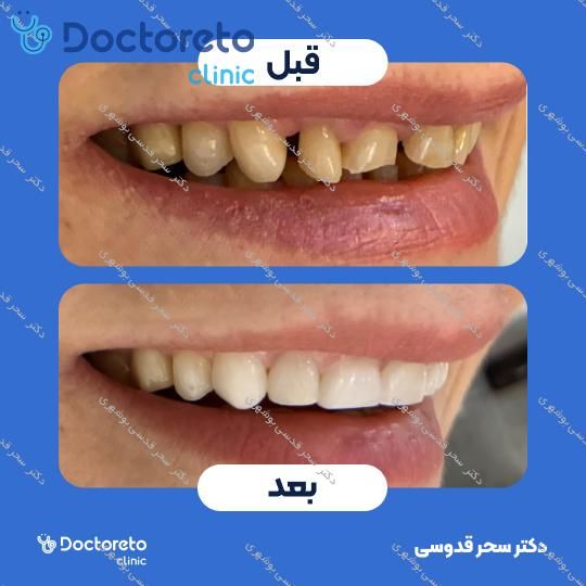 ونیر کامپوزیت توکویاما ژاپنی (هر واحد)