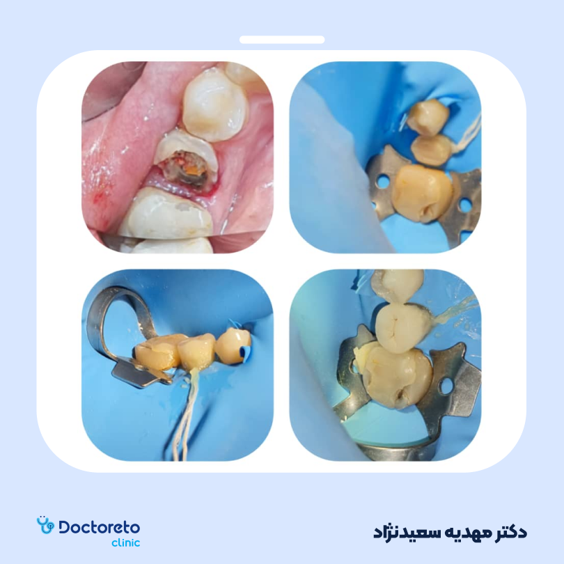 روکش دندان زیرکونیا (هر واحد) دکتر مهدیه سعیدنژاد در تهران 3