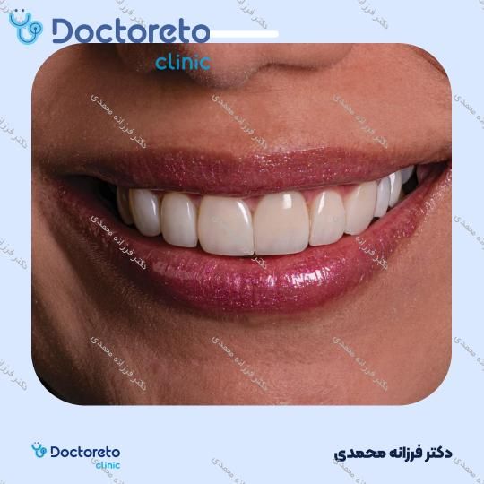 ونیر کامپوزیت توکویاما ژاپنی (هر واحد) دکتر فرزانه محمدی در شیراز 3