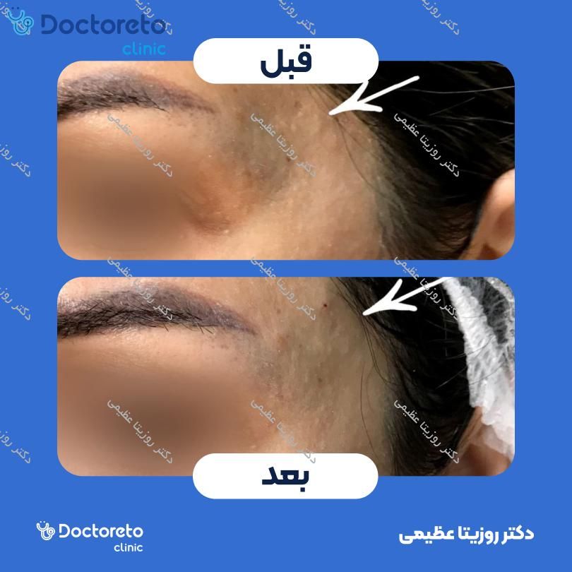 تزریق ژل شقیقه با برند پلوریال (1CC)