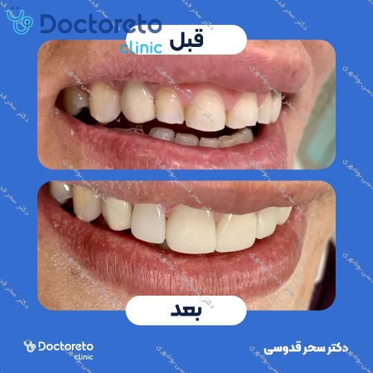 ونیر کامپوزیت توکویاما ژاپنی (هر واحد)