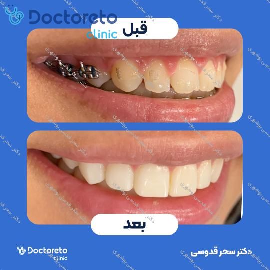 ونیر کامپوزیت توکویاما ژاپنی (هر واحد)