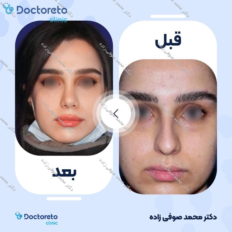 عمل زیبایی بینی (رینوپلاستی) دکتر محمد صوفی زاده در تهران 41