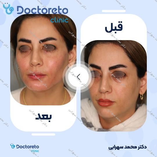 تزریق چربی کامل صورت همراه با نانوفت