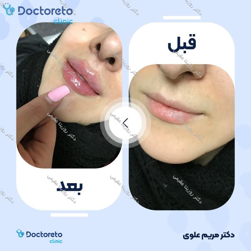 تزریق ژل لب با برند نئوویا (1CC)