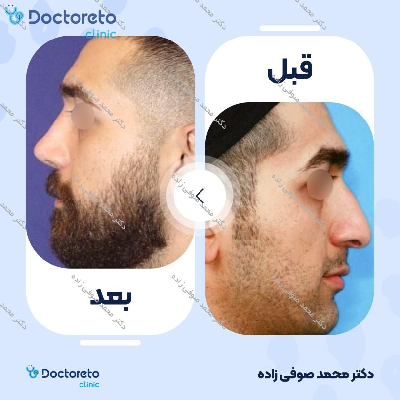 عمل زیبایی بینی (رینوپلاستی) دکتر محمد صوفی زاده در تهران 23