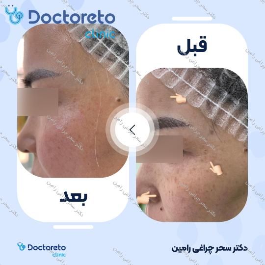 تزریق بوتاکس صورت