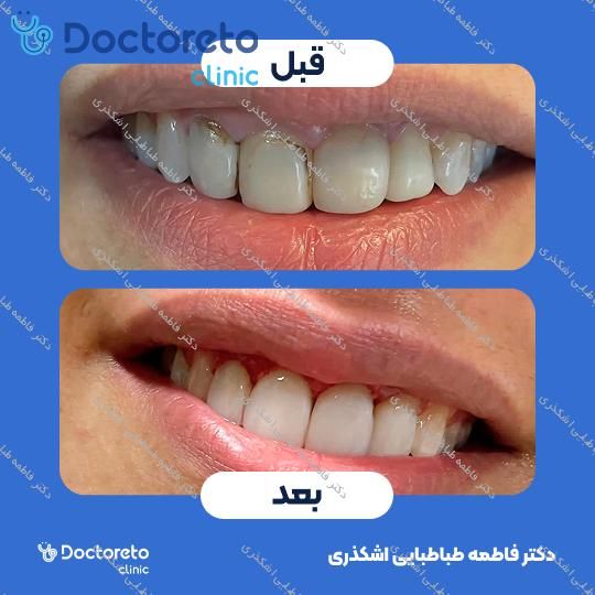 جرم گیری دندان با بروساژ🦷