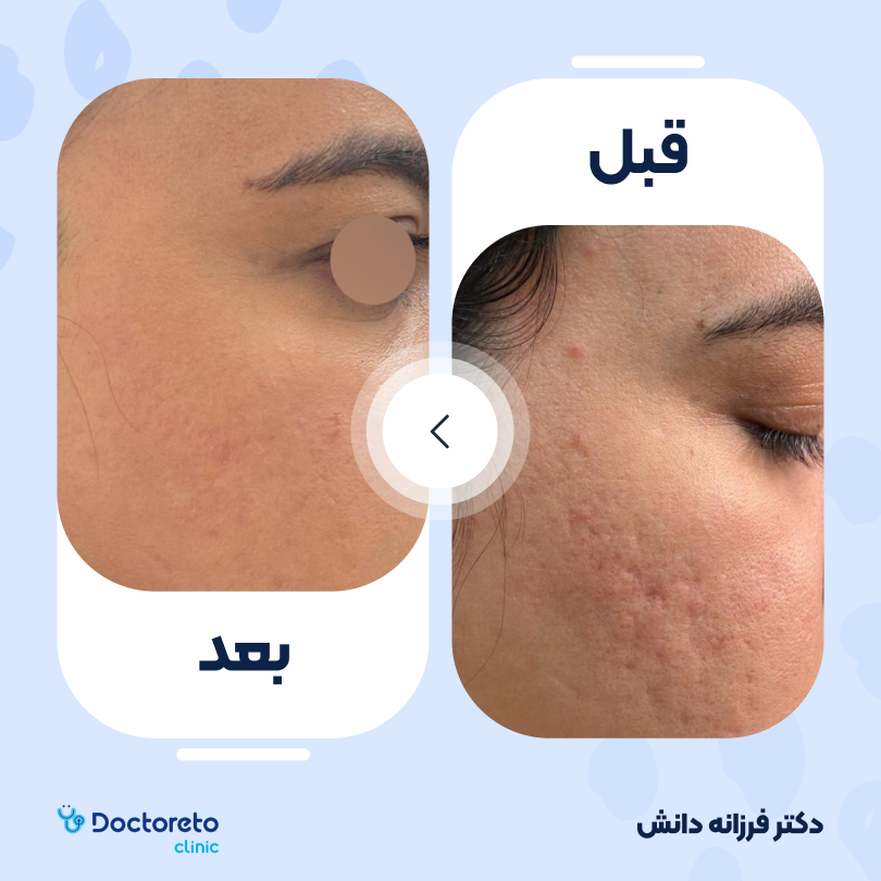جوانسازی و درمان اسکار و آکنه و منافذ باز صورت و گردن با دستگاه لیزر آنجلا (هر جلسه)