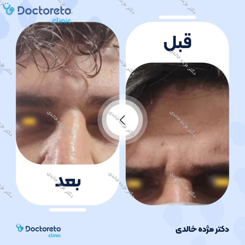 تزریق بوتاکس صورت 💉