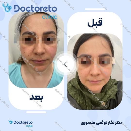 هایفوتراپی