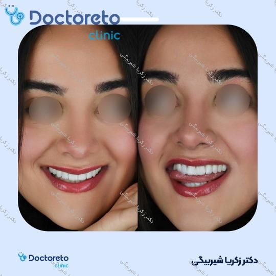 لمینت دندان (هر واحد)