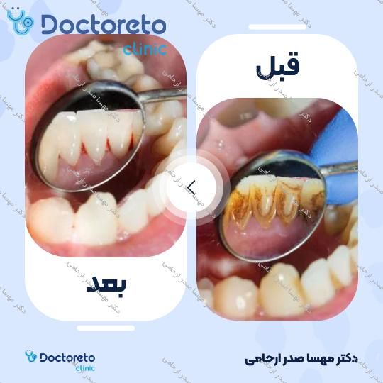 جرم گیری دندان با بروساژ🦷
