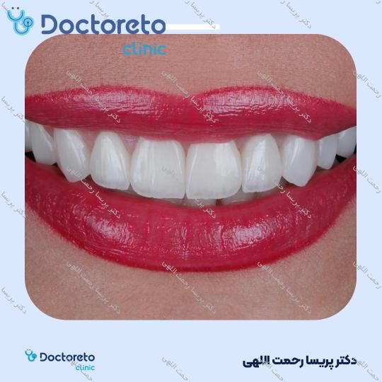 لمینت سرامیکی ایمکس آمریکایی (هر واحد)