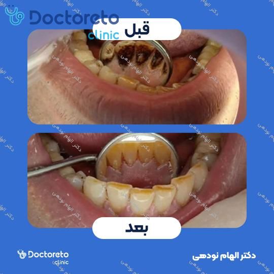 جرم گیری دندان با بروساژ🦷