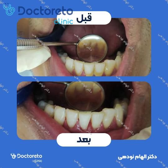 جرم گیری دندان با بروساژ🦷