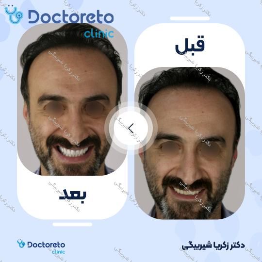 بلیچینگ دندان (سفید کردن دندان)