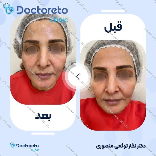 هایفوتراپی