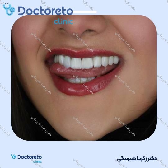 لمینت دندان (هر واحد)