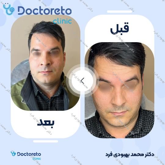 تزریق بوتاکس صورت 💉