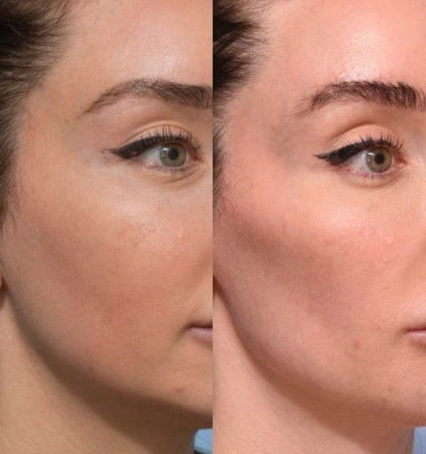 تزریق ژل گونه