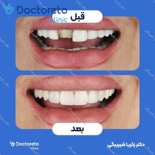 ونیر کامپوزیت (هر واحد)