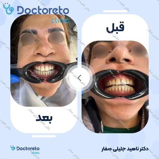 جرم گیری دندان با بروساژ🦷
