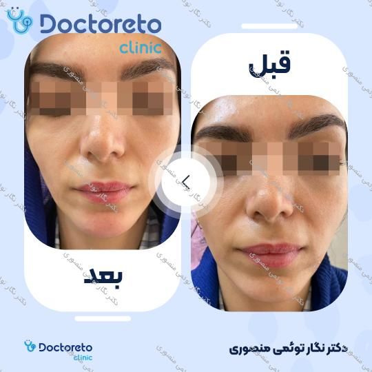 تزریق ژل چانه با برند رووفیل (1CC)