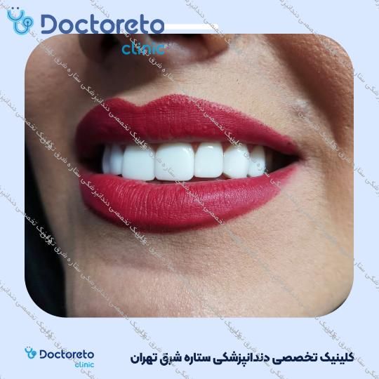 روکش دندان (هر واحد)