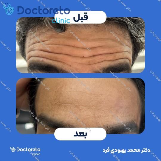 تزریق بوتاکس صورت 💉