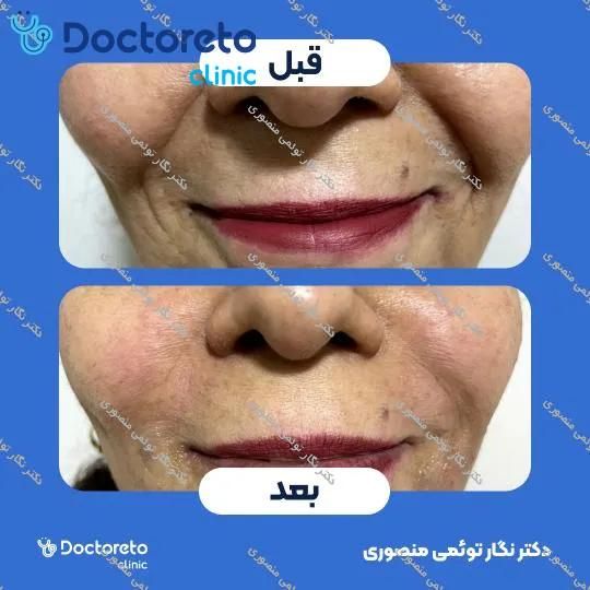 تزریق ژل خط خنده