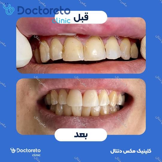 جرم گیری دندان با بروساژ🦷
