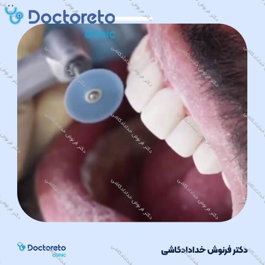 جرم گیری دندان با بروساژ🦷