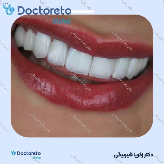 لمینت دندان (هر واحد)