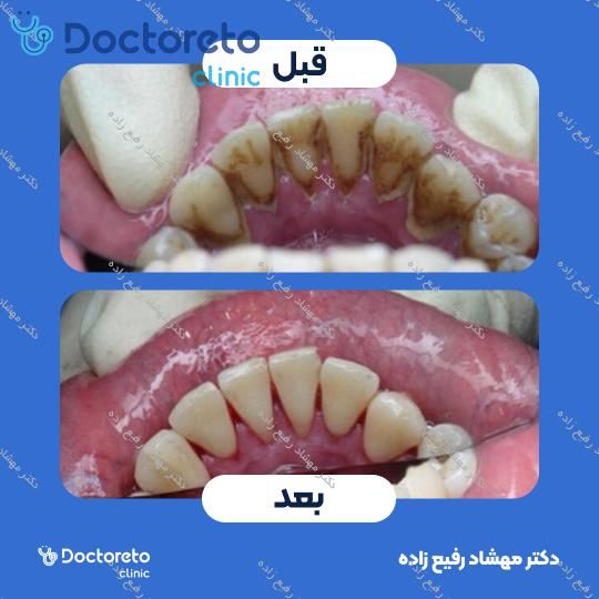 جرم گیری دندان با بروساژ🦷
