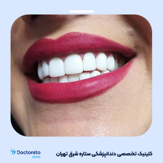 بلیچینگ دندان