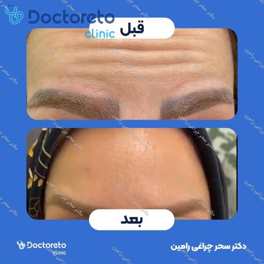 تزریق بوتاکس صورت