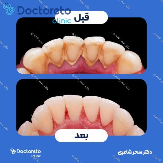 جرم گیری دندان با بروساژ🦷