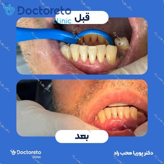 جرم گیری دندان با بروساژ🦷