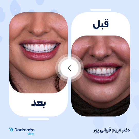 کامپوزیت دندان (هر واحد)