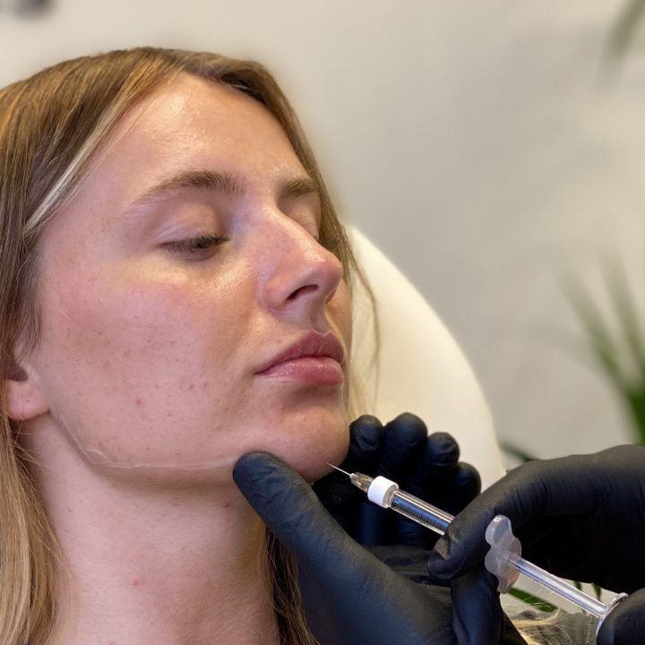 تزریق ژل چانه