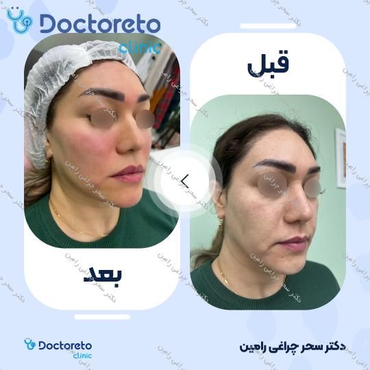 تزریق ژل چانه