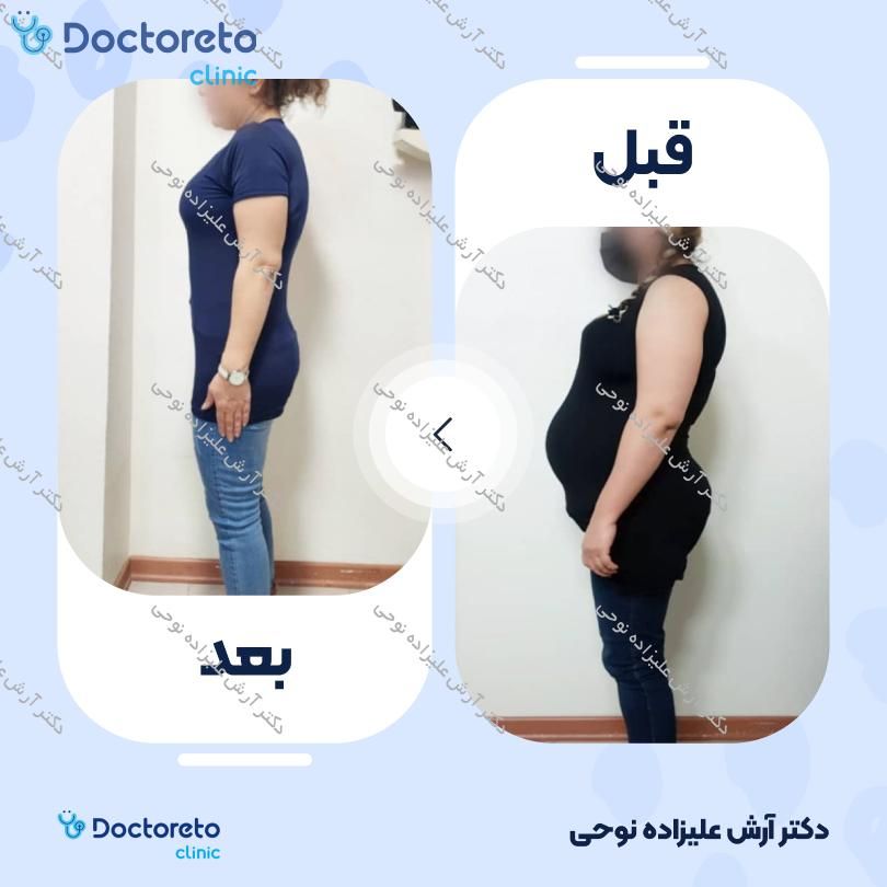 لاغری موضعی با دستگاه کویتیشن، به همراه و رژیم لاغری