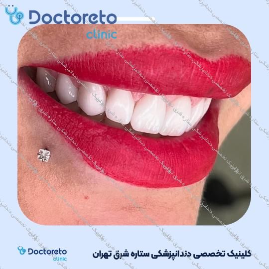 پر کردن دندان