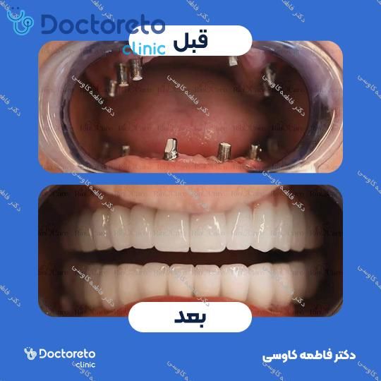 ایمپلنت دندان با روکش
