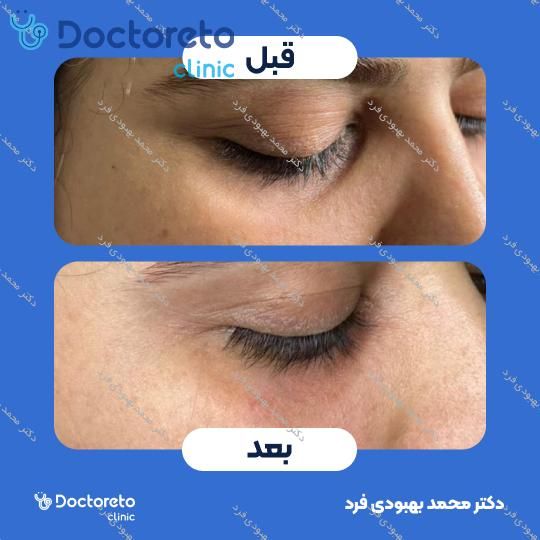 تزریق بوتاکس صورت 💉