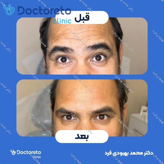 تزریق بوتاکس صورت 💉